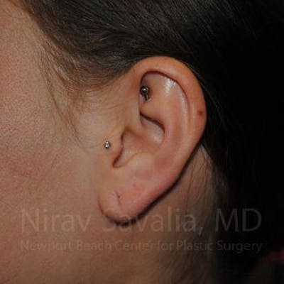Case--1655798 | Before Torn Earlobe Repair Ear Gauge Repair