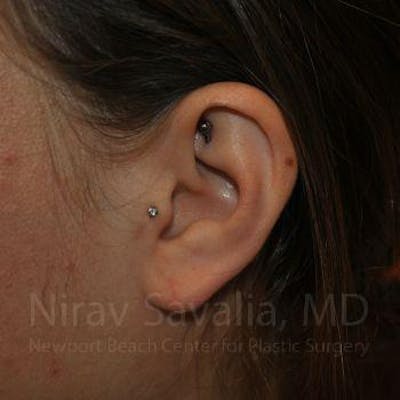 Case--1655798 | After Torn Earlobe Repair Ear Gauge Repair