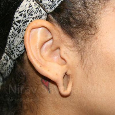 Case--1655800 | Before Torn Earlobe Repair Ear Gauge Repair