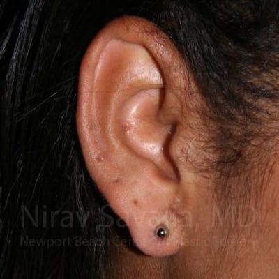Case--1655800 | After Torn Earlobe Repair Ear Gauge Repair