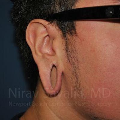 Case--1655801 | Before Torn Earlobe Repair Ear Gauge Repair