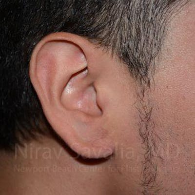 Case--1655801 | After Torn Earlobe Repair Ear Gauge Repair